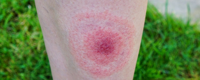 La maladie de Lyme ne bénéficie pas toujours d’un traitement adapté en France