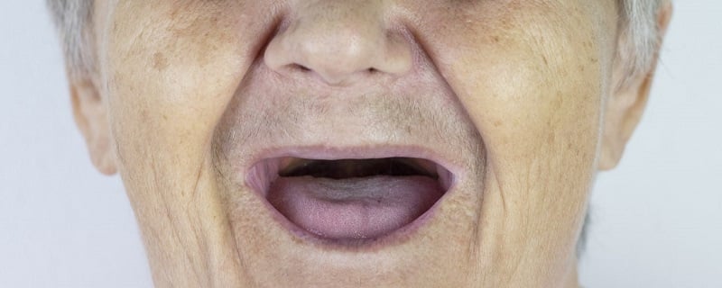 La perte de dents présente des risques pour la santé des personnes âgées