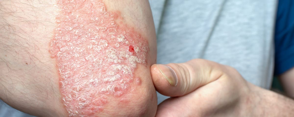 Psoriasis : combattre les préjugés, renforcer la prise en charge médicale