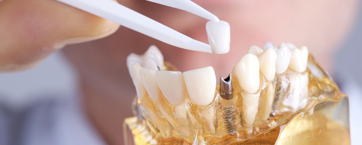 Assurance santé : vers un remboursement plus étendu des implants dentaires