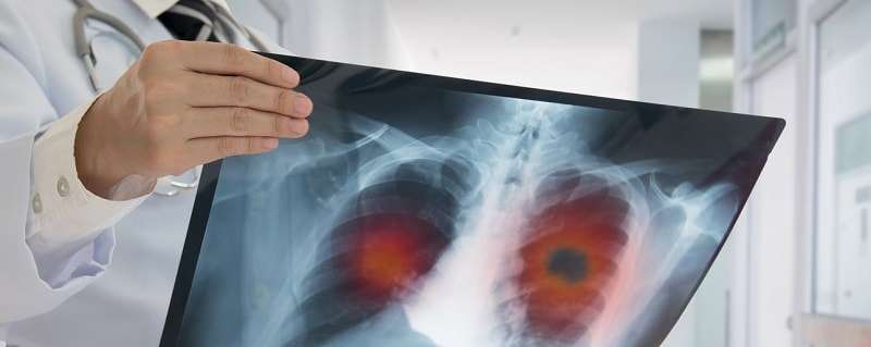 Cancer poumon et assurance de prêt immobilier