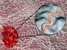 Ulcère de l'estomac