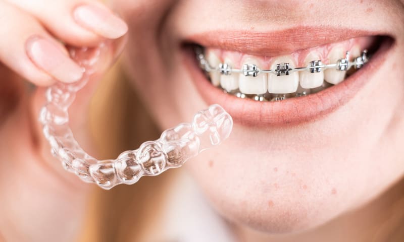 Mutuelle orthodontie adulte